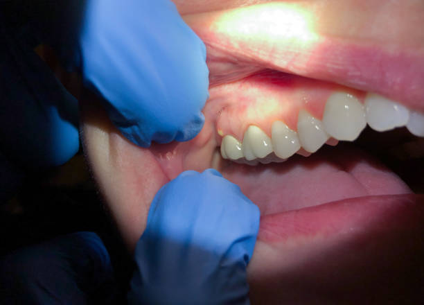 Best Emergency Denture Repair in Mccordsville, IN
